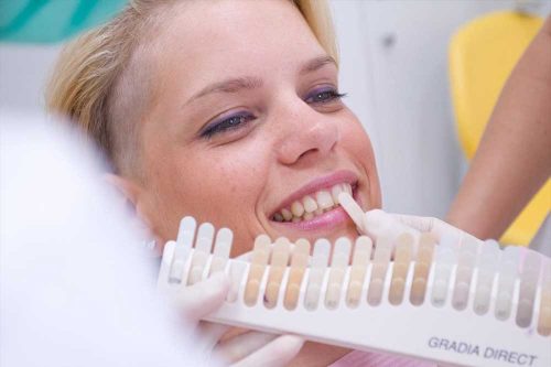 faccette estetiche personalizzate